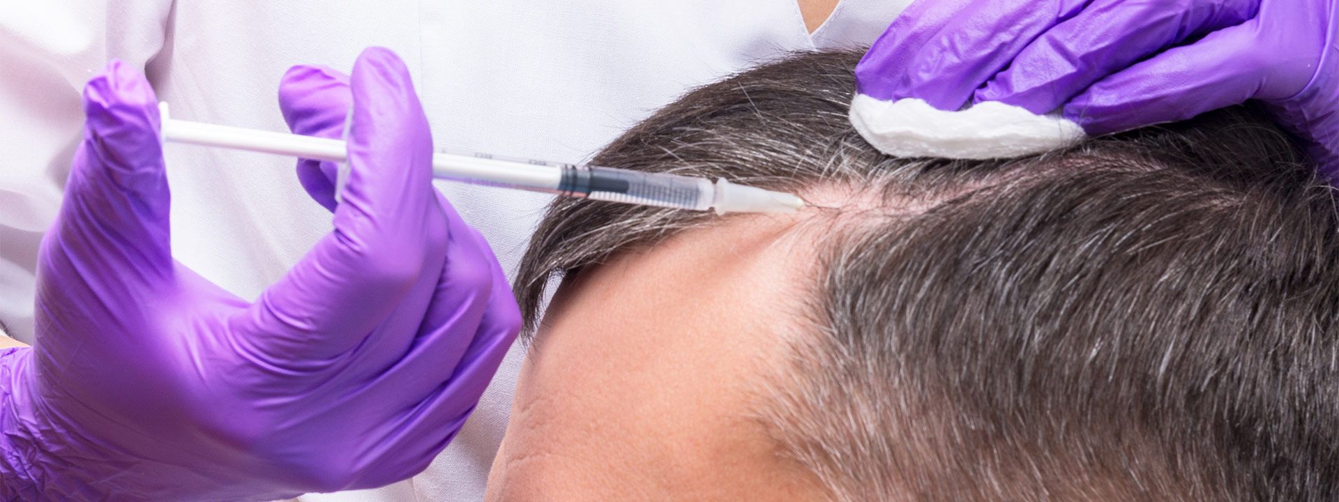Saç Mezoterapisi