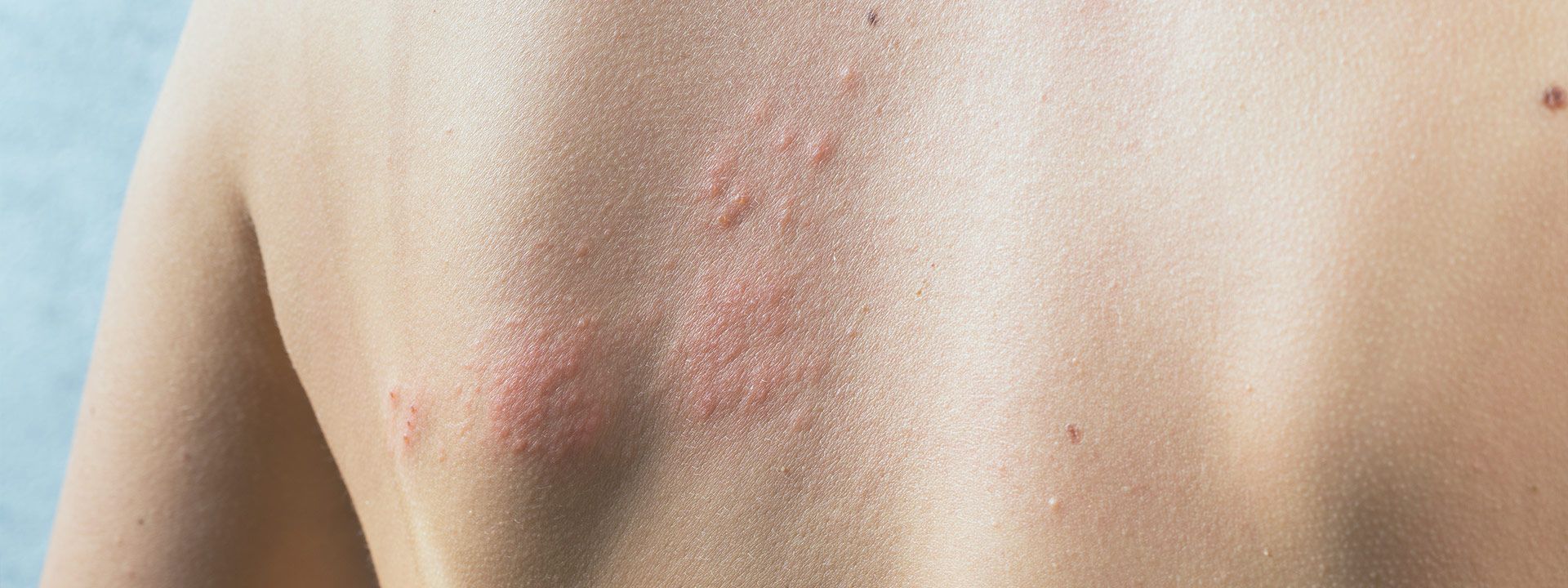 Zona Hastalığı Tedavisi